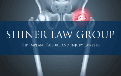 Hip Implant Injury and Failure Lawsuits