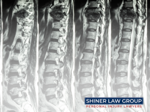 Spinal Cord Injuries Due To Semi-truck Accidents